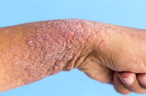 Triển khai phòng khám vảy nến tại Bệnh viện Da liễu Đăng Nhập Chính Thức OK9