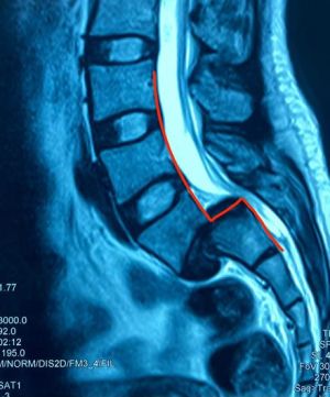 Bệnh viện Hoàn Mỹ ITO Đăng Nhập Chính Thức OK9 thực hiện thành công ca phẫu thuật, điều trị trượt thân đốt sống độ 4