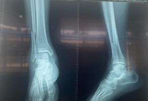 Phẫu thuật kết hợp xương cho bệnh nhân bị gãy xương do tai nạn Link Đăng Ký Đăng Nhập Nhà Cái OK9 Chính Thức